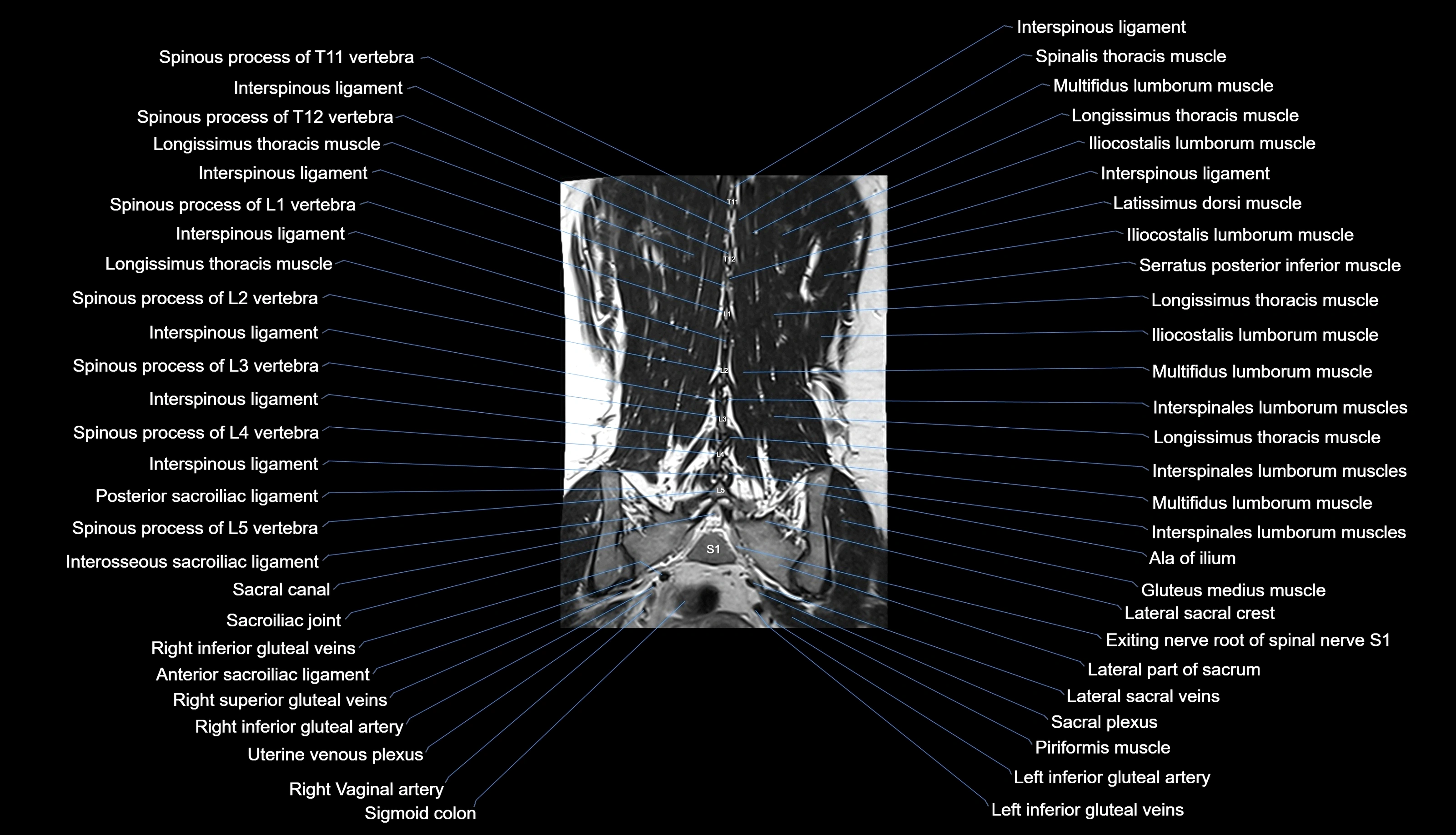 MRI lumbar spine labelled coronal cross sectional anatomy 3T radiology-img-00001-00028.webp